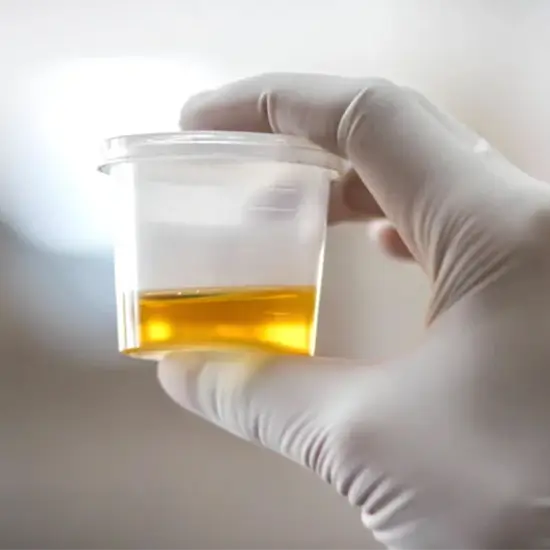 uric acid, random urine test